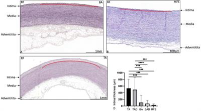 Thoracic aortopathy in Marfan syndrome overlaps with mechanisms seen in bicuspid aortic valve disease